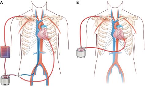 lv venting|lvad vs ecmo.